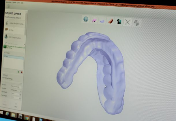 CAD Splint Design