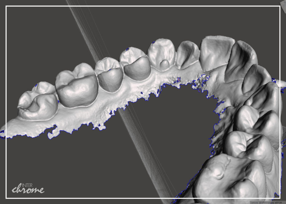 Maxillary Scan with many holes and voids in the information