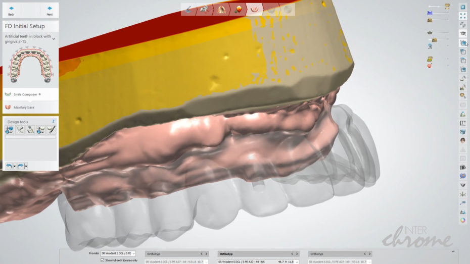Digital denture design on top of the bar
