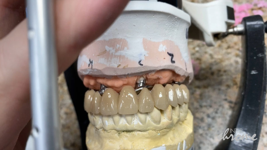 Milled teeth created from the prototype