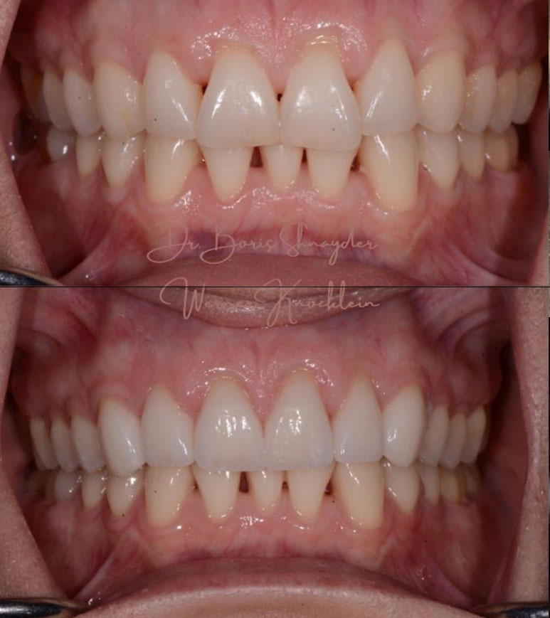 emax veneers