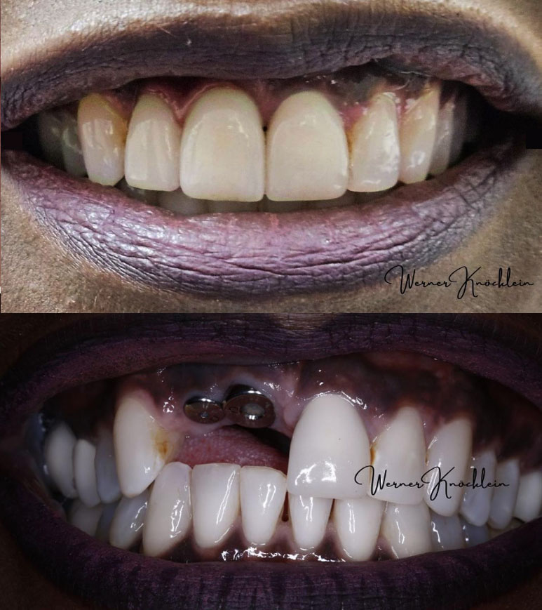 implant crowns before after