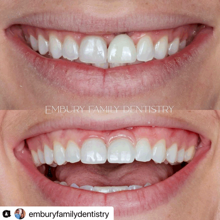 emax veneers