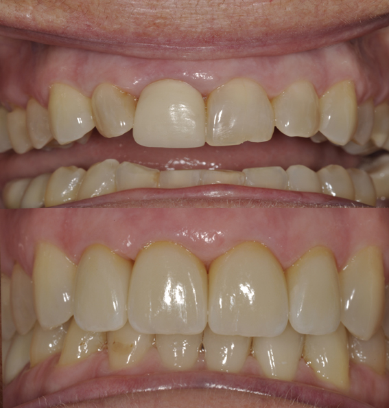 emax veneers